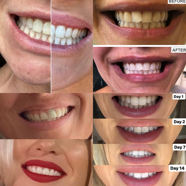 Before and After: The Impact of Bliss Whitening Power