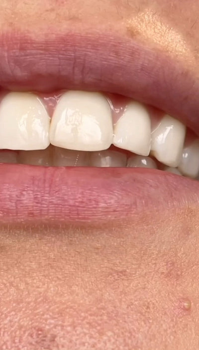 Safe Whitening Products: Achieve At-Home Brilliance with Ease