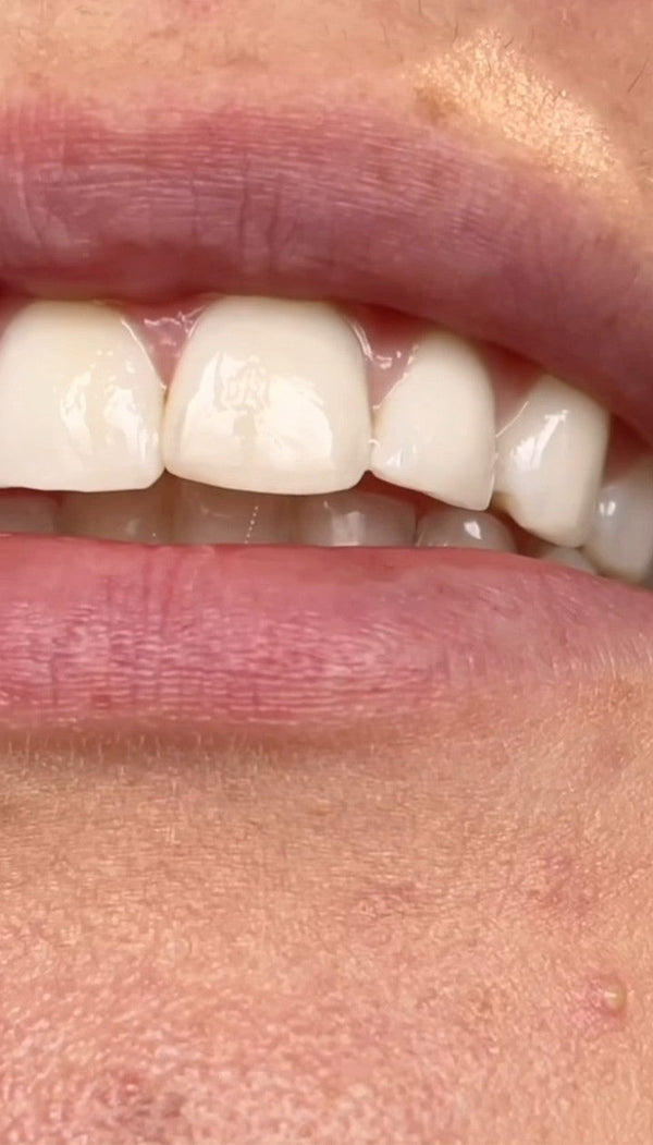 Safe Whitening Products: Achieve At-Home Brilliance with Ease