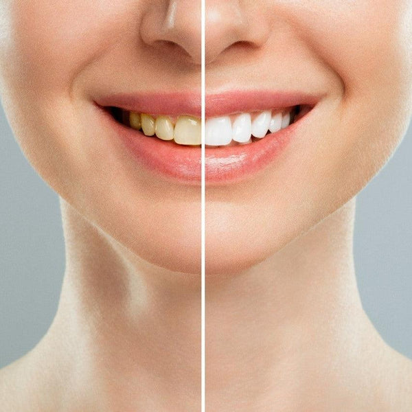A Detailed Look: Teeth Cleaning vs. Teeth Whitening