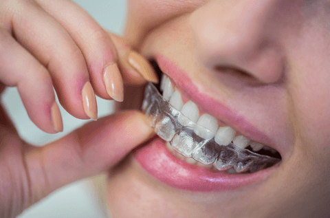 Most Effective Way to Whiten Teeth with Invisalign
